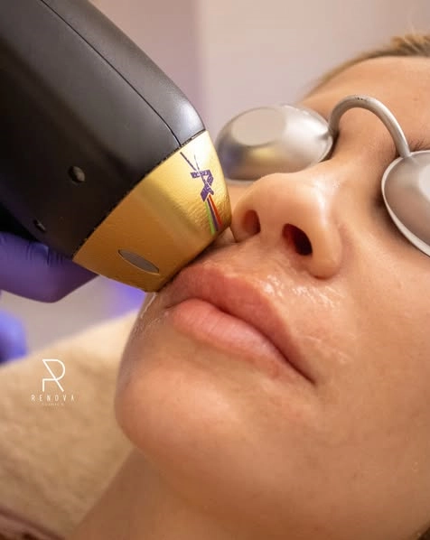 tecnología alma laser la orotava