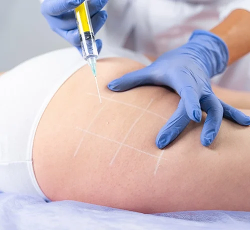 mesoterapia corporal precios